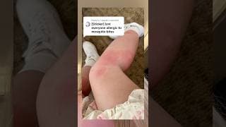 How bad my Thailand mosquito bites started