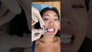 Teeth whitening in Korea🦷🤩 #korea #teethwhitening