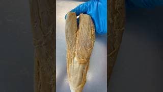 Calf Muscle That Looks Like a Fish